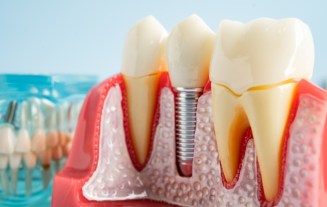 Dental Implants